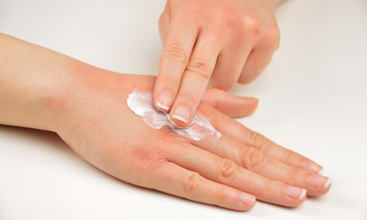 Tratamento da psoríase con crema Keramin