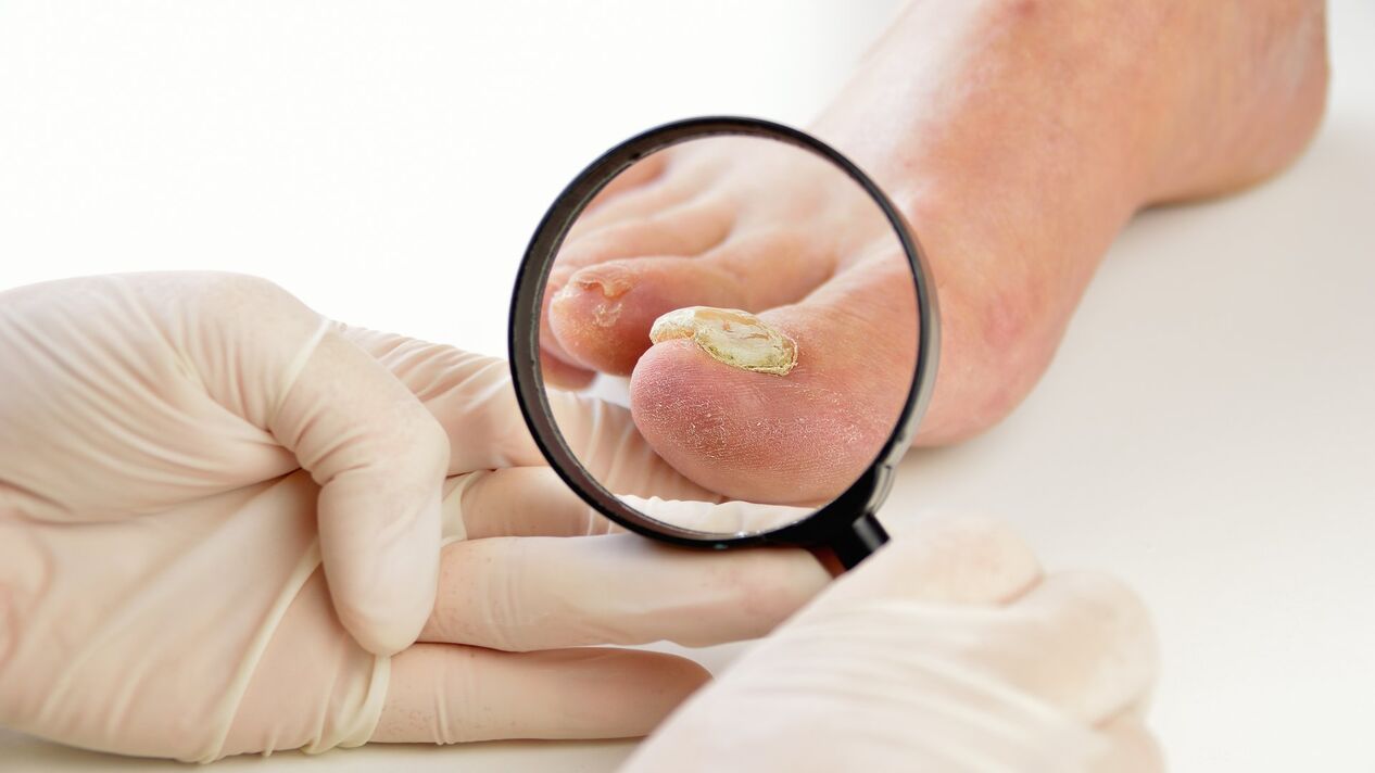 Tratamento de fungos nas unhas con crema Keramin