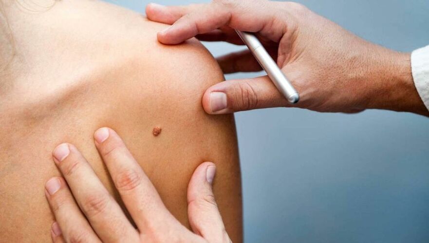 Un dermatólogo examina un paciente con papiloma