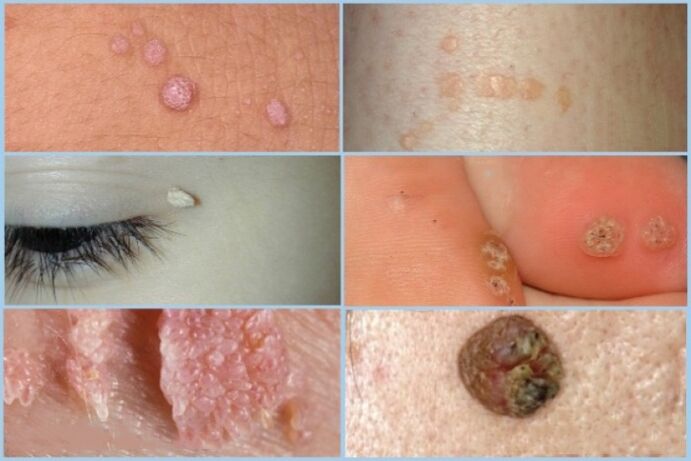Tipos de papilomas na cara e no corpo