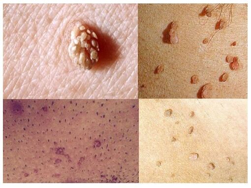 Verrugas xenitais no corpo
