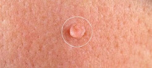 Verrugas xenitais no corpo