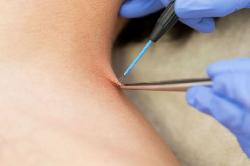 O procedemento para eliminar papilomas mediante electrocoagulación