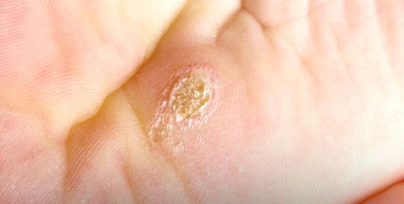 Verruga plantar (verruga espinal)