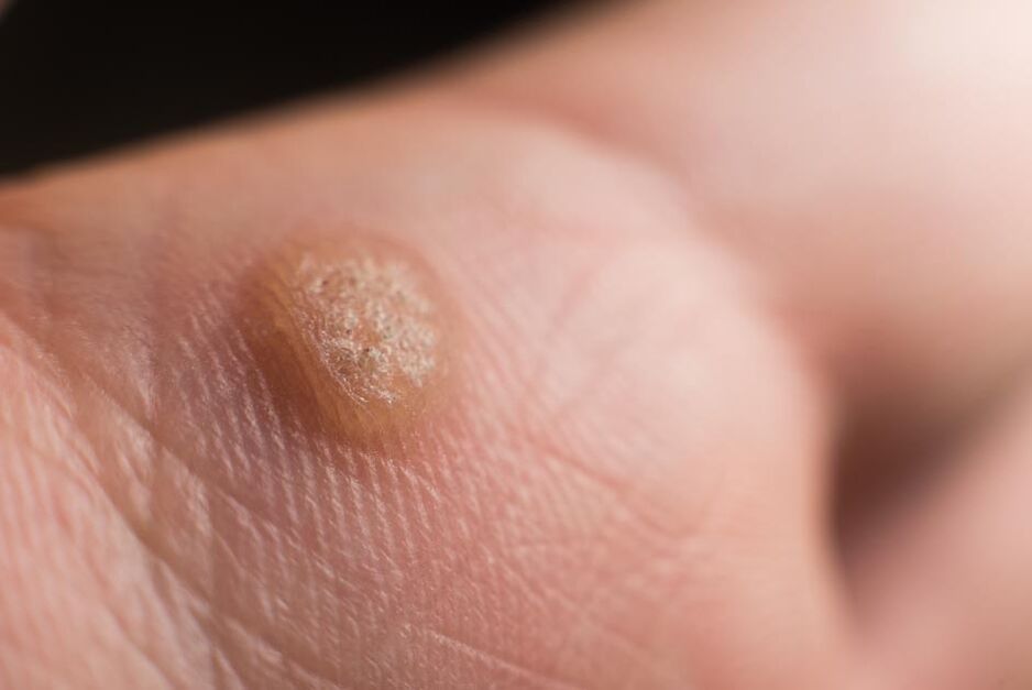 Virus do papiloma humano na pel